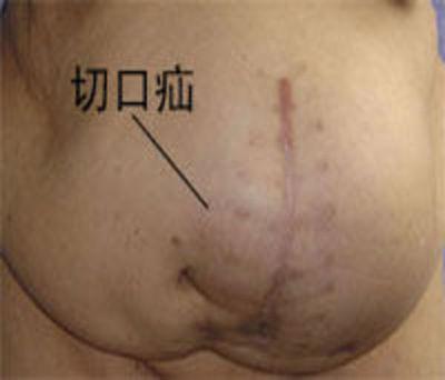 宏康专家为您详细分析切口疝