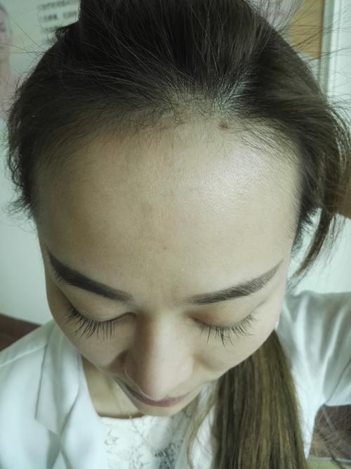 这是我术前的一个照片,发际线有点高,m型-发际线种植