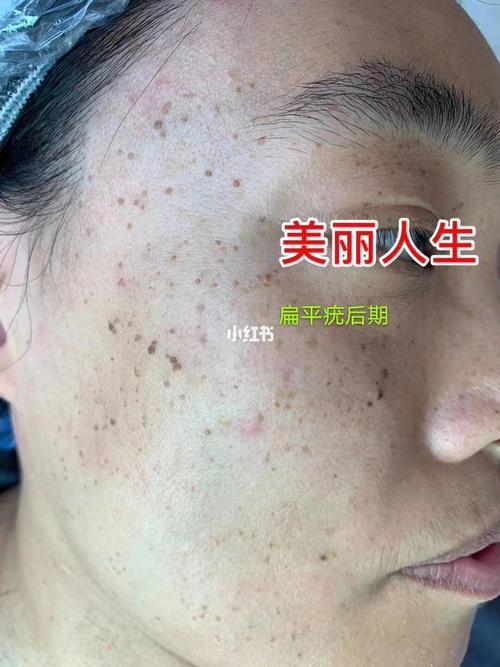 这就是扁平疣前期,中期,和后期发展趋势,扁平疣在不同