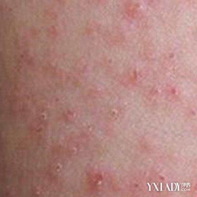 【图介绍几种常见皮肤病症状 了解它们的不同之处