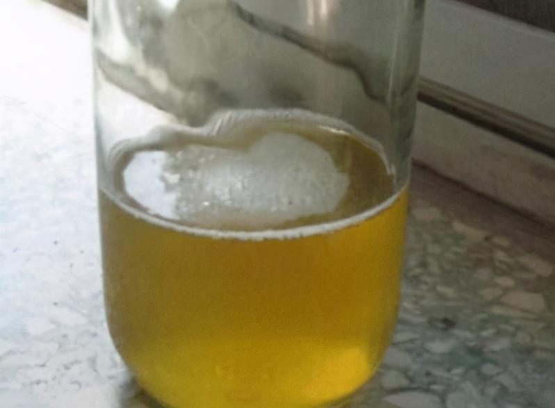 判断尿蛋白是轻是重?2项指标才是金标准!附上降蛋白攻略_尿液