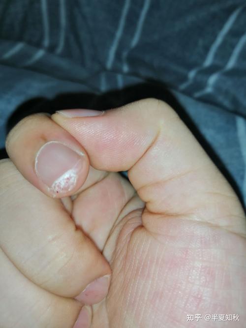 我与甲下疣的爱恨情仇