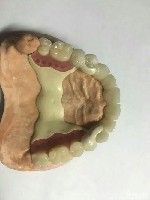 华维工作室/生物材料hpp义齿修复应用