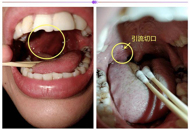 扁桃体发炎脓肿危害挺大 成都民生耳鼻喉医院详解扁桃体化脓