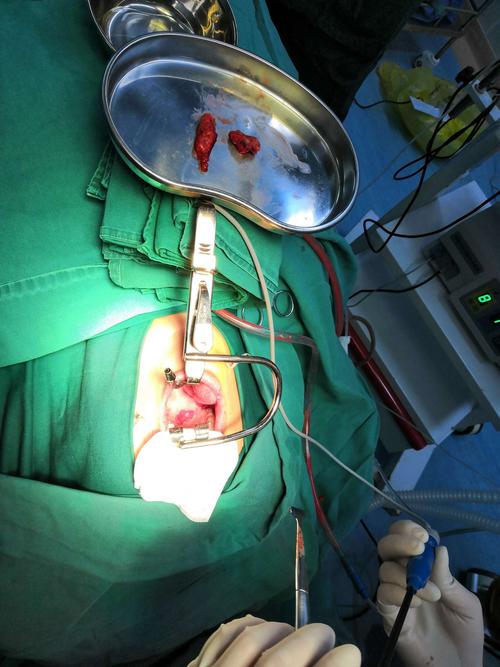 黎平县人民医院五官科率先完成我县首例低温等离子扁桃体手术