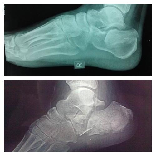 青海省康乐医院骨科带您了解跟骨骨折