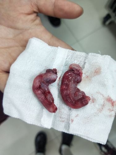 有形状可怕子宫