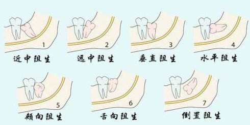 智齿常见的问题答疑汇总