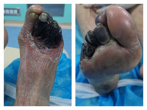 【下肢动脉闭塞证科普】下肢跛行或静息痛,甚至出现足坏疽,应早防早治