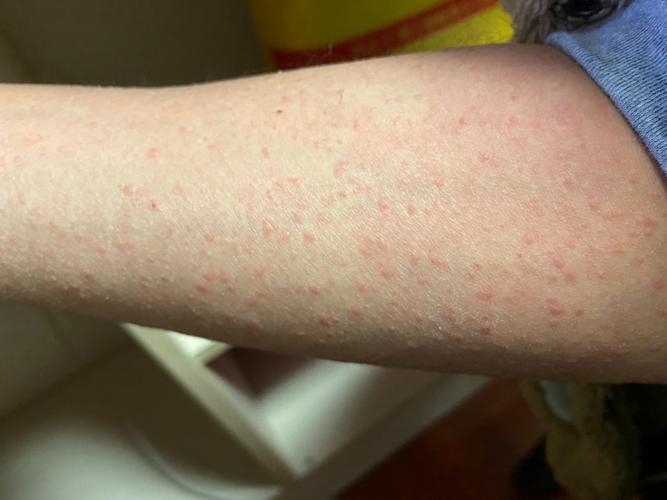 皮疹咋办