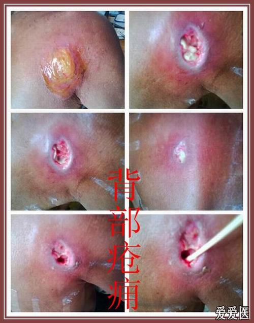 左背后生疮的病人