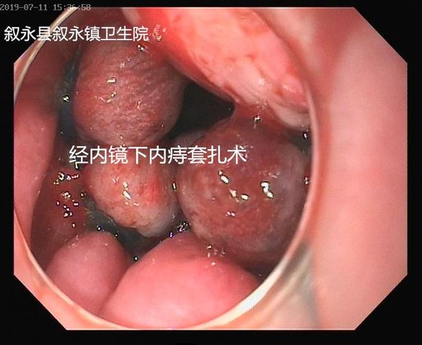 无痛痔疮手术来啦!我院在市内率先开展经内镜内痔套扎