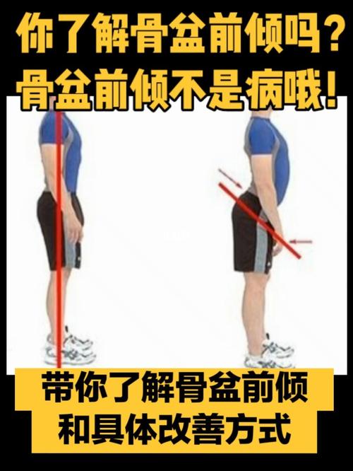 骨盆前倾_mcnicoll park攻略_拉伸_医疗健康_医疗方法