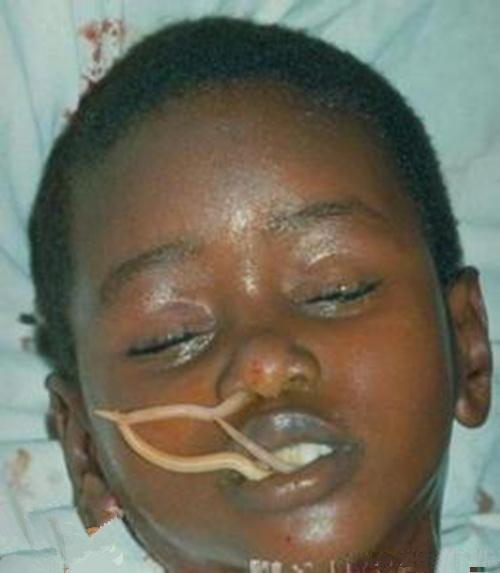 肠绦虫病介绍_肠绦虫病病因_肠绦虫病治疗_肠绦虫病