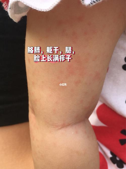 验血出来显示是细菌性炎症(用于区别细菌性感染引起的发烧还是病毒性