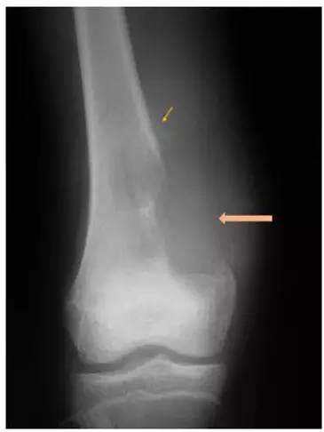 5分钟学会骨肉瘤的诊断要点