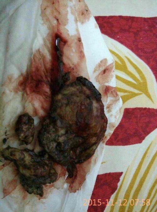 纳氏囊肿反馈】53岁的阿姨这体内到底有多少