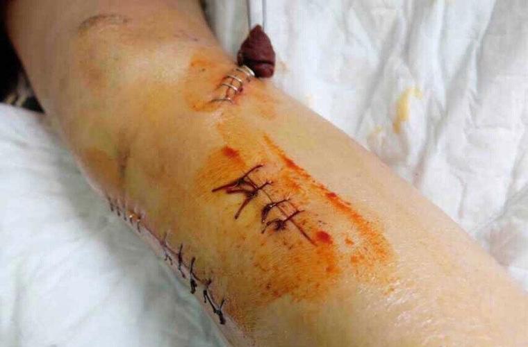 河南美女主播周昊被撞伤多处粉碎性骨折 3名醉酒男子驾宝马逃逸【3】