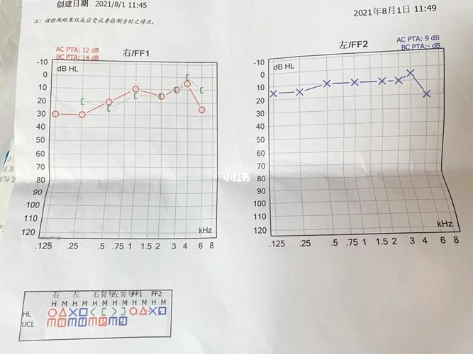 纯音听阀测定_耳鸣_特发性突聋_医疗健康_医疗健康其他