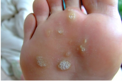 寻常疣,俗称瘊子,初期为针尖大小的皮肤隆起小点,逐渐扩大到豌豆大或