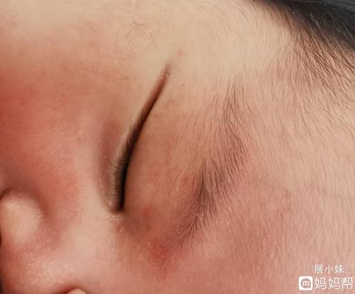 能帮我看看眼睛周围起的小红点是什么,过敏