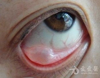 这就是结膜囊肿