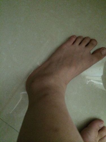 脚肿了一个月还没好会不会是骨折了?