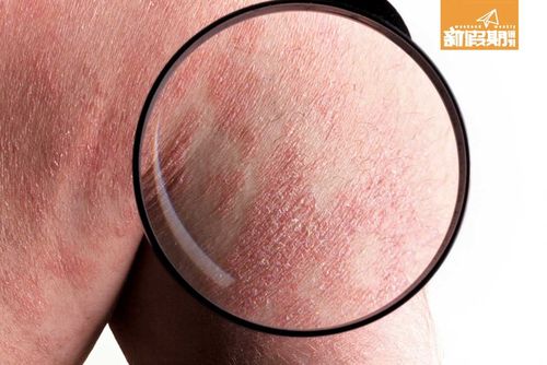 长期吃热气食物会引起不同的疾病,轻则生暗疮,湿毒疮,如果本身皮肤不