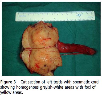 睾丸切除样本的组织病理学显示生发中心型的弥漫大b细胞淋巴瘤.