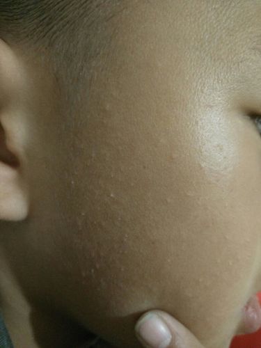 我家小孩脸上长了一脸的小籽籽,是毛周角化症吗