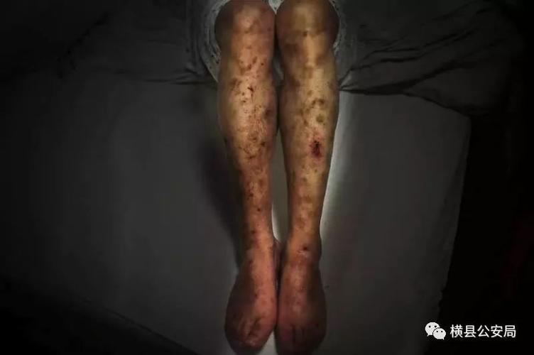 严重者膀胱萎缩,肾功能受损. ←吸毒