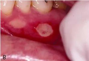 口腔溃疡不用怕药师帮你想办法