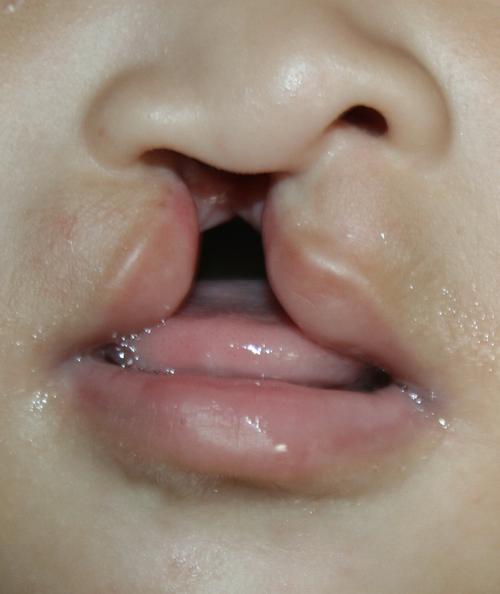 先天性唇裂如何治疗