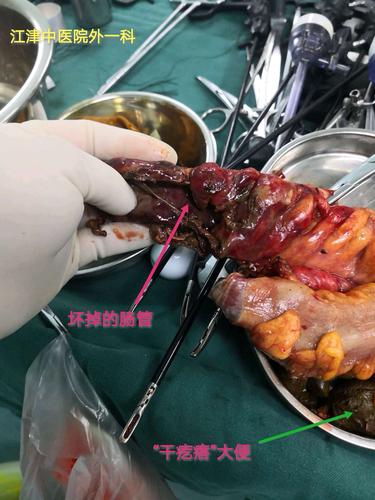 ——一例腔镜直肠穿孔乙状结肠及直肠中上段切除 降结肠造瘘术.