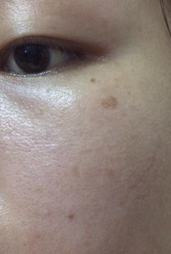 我这个是属于什么类型的斑呢?