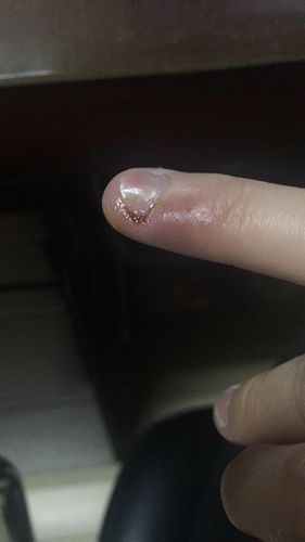 上个星期就是指甲边有皮我就拉了一下刚开始出血我也没太在意后来