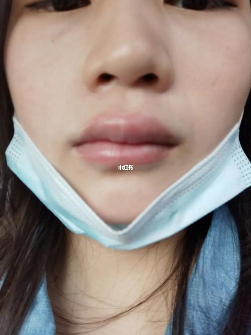 早上起来上嘴唇肿了是怎么回事啊_医疗健康_医疗健康