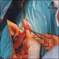 男人变女人 变性手术过程图示