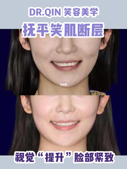 北京牙齿矫正 北京箍牙 北京牙套 龅牙 嘴突_牙齿矫正