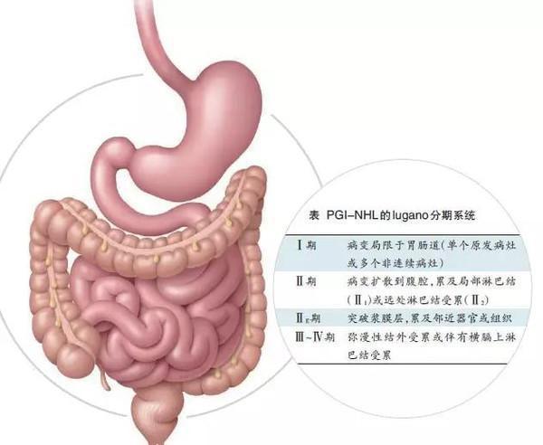 例如暗红色大便,可见于消化道出血性疾病,如上消化道大出血,痔疮
