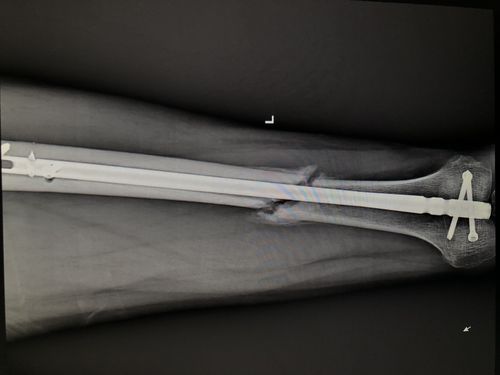 术后6个月见少量骨痂