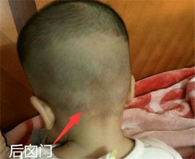 顺产分娩,经过产道挤压,新生宝宝的囟门会提早闭合吗?