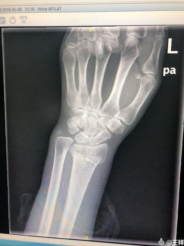 左桡骨远端粉碎性骨折修复术