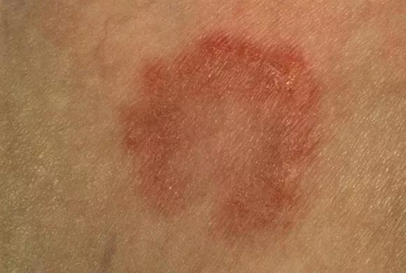 2.细菌性皮肤病:胶疮疮,麻风,皮肤结核等均可通过接触而传染. 3.