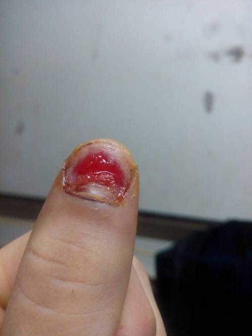 拔完指甲后根部肿了是怎么回事?