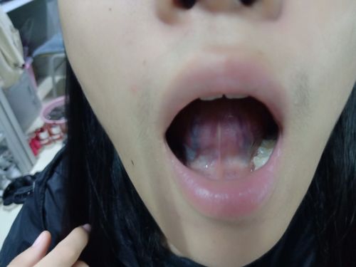 舌下络脉正常