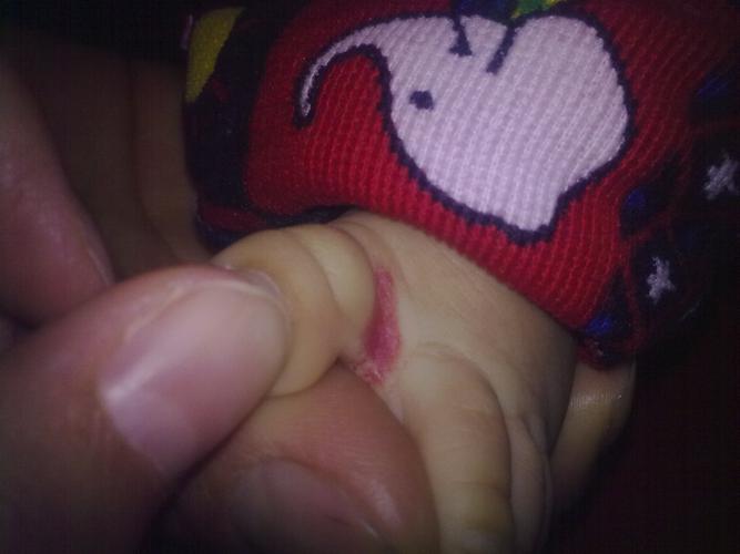 宝宝脚上长个血管瘤,请知道看下这是什么类型的血管瘤