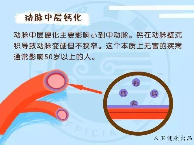 动脉硬化是动脉变硬了吗?有什么危害呢?