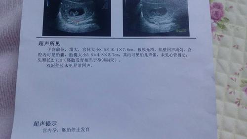 12周查出胎停 九周 4停的 好伤心