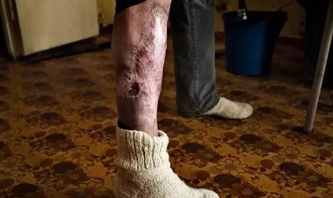 原创最恐怖的毒品:吸食后肌肉由内向外腐烂,最后露出白骨,人却没死